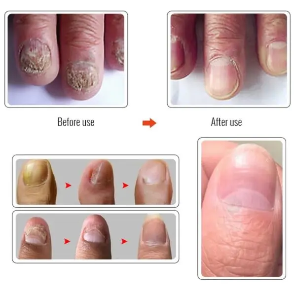 Nail Infections Treatment Serum