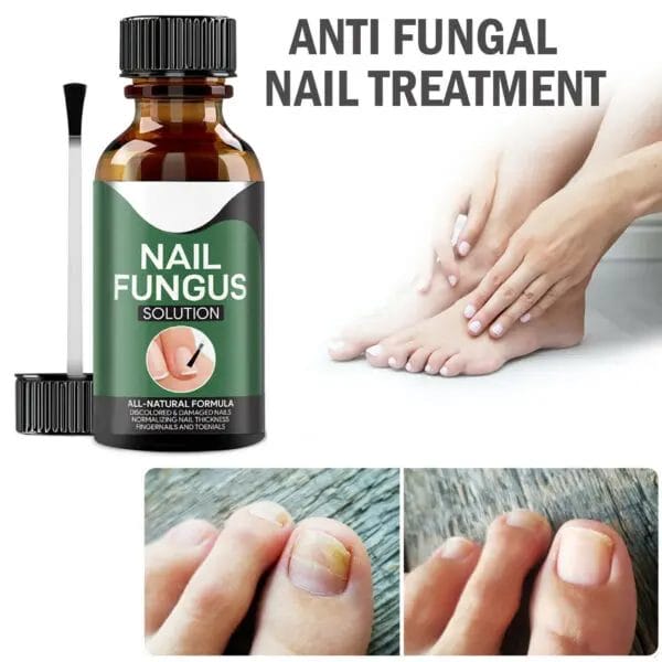 ANTI FUNGAL Toenail Fungus Treatment