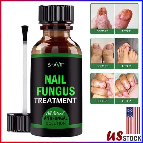 SHAVIT Natural Toenail Fungus Treatment