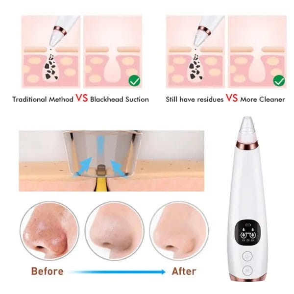 Ultra-Powerful Pore Vacuum Pro: Expert Blackhead Removal & Rejuvenation System